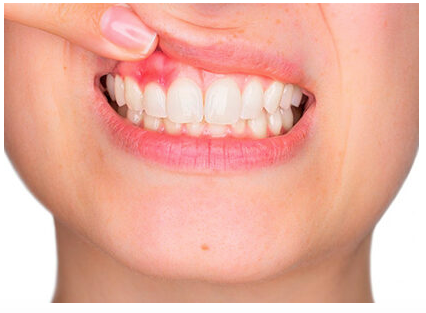 Qué es la periodontitis